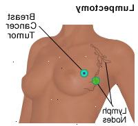 Ilustração de uma mastectomia