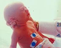 Imagem de um recém-nascido na unidade de terapia intensiva neonatal