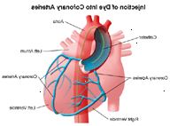 Ilustração das artérias coronárias após a injeção de corante utilizado em cateterismo cardíaco ou PTCA