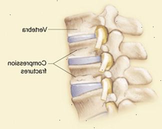 Vista lateral de vértebras e discos mostrando fraturas por compressão das vértebras lombares.