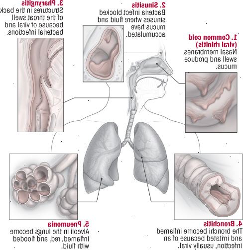 Cinco infecções do trato respiratório
