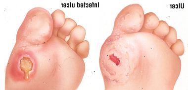 Úlcera do pé