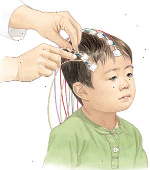 Durante um EEG, eletrodos são colocados no couro cabeludo do seu filho para que a atividade elétrica do cérebro pode ser gravado.