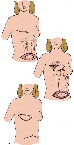 Procedimento TRAM mostrando como tecido abdominal é utilizada para reconstruir a mama removida