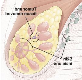 Anatomia da mama com círculo em torno do tumor na conduta mostrando tecido a ser removido. Há linhas pontilhadas acima do mamilo e na axila para mostrar pequenas incisões curvas.