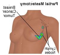 Ilustração de uma mastectomia parcial