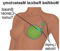 Ilustração de uma mastectomia radical modificada