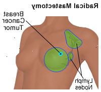 Ilustração de uma mastectomia radical
