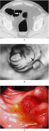 Pólipo colorretal no cólon sigmóide visto por tomografia computadorizada (A), a colonoscopia virtual (B), e colonoscopia convencional (C).