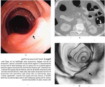 Carcinoma Cecal e pólipo visto por tomografia computadorizada (A), colonoscopia virtual (B), e colonoscopia convencional (C).