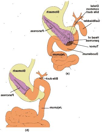 Piloro-preservação pancreaticoduodenectomy: anatomia da área ressecada (a) e do trato digestivo reconectado com Pancreaticojejunostomia end-to-end (b).